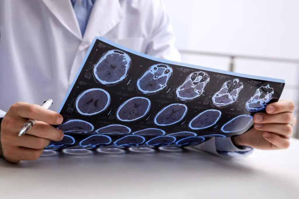 Okanagan Vision Therapy - Vision Therapy Kelowna - Concussion Recovery