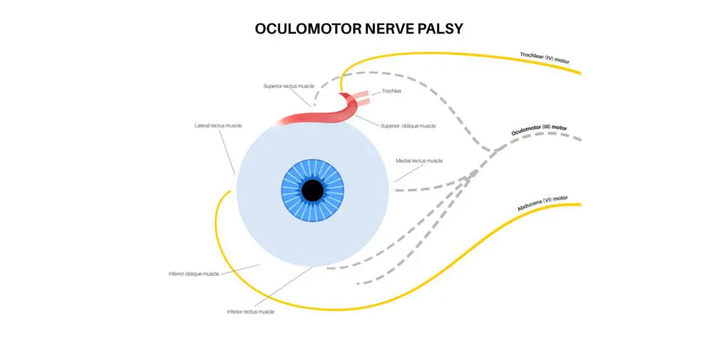 Vision-Therapy-Kelowna-Kelowna-Vision-Therapy-Palsy