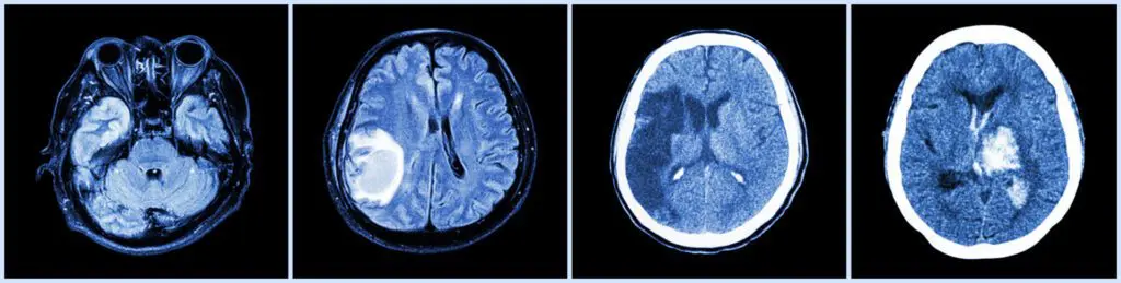 Vision Therapy Kelowna - Okanagan Vision Therapy - Trauma